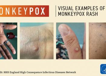 Emergency Committee meets again as Monkeypox cases pass 14,000: WHO |