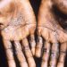 Monkeypox: How it spreads, who’s at risk – here’s what you need to know |