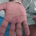 WHO: ‘We believe Monkeypox outbreak can be stopped’ |