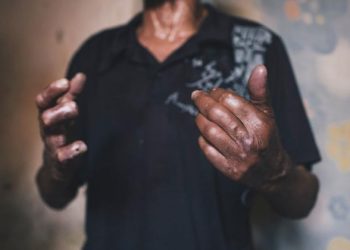 UN rights expert calls on Bangladesh to draft anti-discrimination leprosy laws